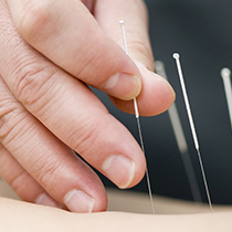 Dry Needling